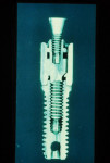 Fig 2. The original standard abutment sits on top of an external hex implant. The abutment keeps the restoration off the tissue, providing ample space for the patient to clean (a high-water design). The little final prosthetic screw is specifically designed that way so that if any undue force reached the abutment, the screw would break before damaging the abutment or the implant.