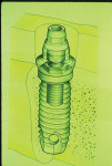 Fig 3. The original standard abutment sits on top of an external hex implant. The abutment keeps the restoration off the tissue, providing ample space for the patient to clean (a high-water design). The little final prosthetic screw is specifically designed that way so that if any undue force reached the abutment, the screw would break before damaging the abutment or the implant.
