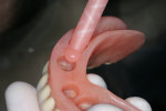 Figure 13  Pick-up material was applied into the openings in the denture.