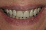 Figure 1  Preoperative smile view.