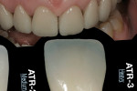 Figure 3  Deep transparency—color for laterals and canines would be Base A-1