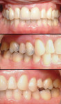 Figure 12  Posttreatment intraoral view. Note correction of complete buccal crossbite of tooth No. 13.