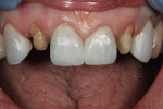 Figure 12  Teeth Nos. 8 and 9 were checked for mesial symmetry.