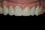Figure 15  Immediate view of the final restorations after cementation.