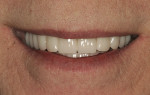 Figure 8  Completed dentures utilizing the Filou 28 Denture set-up system and Mondial<sup>®</sup> anterior and posterior teeth