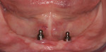 Figure 9: Solitary implant ball-abutments in site Nos. 23 and 26.
