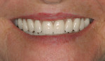 Figure 11  Completed maxillary complete denture and mandibular overdenture. Premium<sup>®</sup> teeth, Heraeus.