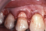 ADM placed over root surface and below gingival flap