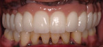 Figure 12  Edentulous maxilla: implant-supported fixed partial denture with eight Nobel Biocare Select<sup>®</sup> dental implants. Porcelain-fused-to-metal cross-arch stabilized substructure and individually bonded all-ceramic restorations.