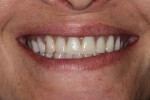 Preoperative smile photograph with maxillary complete denture in place.
