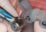 A tissue punch is used to remove the epithelium from the osteotomy site.