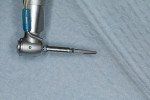 Tapered osteotomy bur used to prepare the site for implant placement.