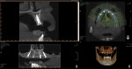Postoperative CBCT demonstrating ideal positioning of the four dental implants.