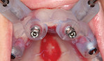 Dental implants hand-torqued into position through the surgical guide.
