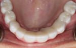 Occlusal view of the fixed prosthesis in position.