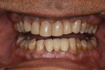 Preoperative close-up retracted view of the patient’s upper and lower arches, revealing
intrinsic discoloration and malocclusion.