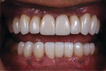 Postoperative closeup retracted view of the definitive maxillary and mandibular lithium disilicate restorations.