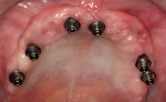 Figure 4   Implant abutments in situ.