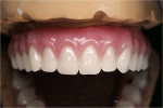 Figure 15  The final denture on the model.