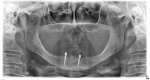 Fig 1. Panoramic radiograph demonstrating two Zest LOCATOR Overdenture 2.9-mm by 14-mm implants in the anterior mandible. (Surgery by Georgios Romanos, DDS, PhD.)