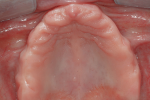 Fig 4. Occlusal view of maxillary edentulous ridge.