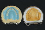 Fig 18. Flasked maxillary tooth arrangement after wax elimination.