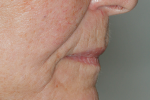 Fig 26. Right profile view of esthetic facial profile and adequate lip support.