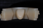 Fig 1. Pre-shaded multilayer zirconia offers a color gradient similar to natural esthetics.