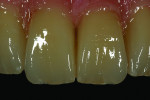 Fig 9. Monolithic zirconia can also be used to fabricate hybrid prostheses.