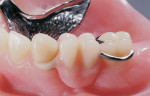 Figure 2  Acetal resin (Thermoflex) RPD with tooth-colored clasps.