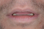 Fig 2. Lips in repose, initial situation.