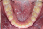 Fig 4. Lower arch, initial situation. Note questionable restoration on tooth No. 30.