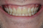 Fig 8. Mock-up for functional and esthetic evaluation.