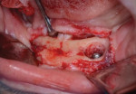 Fig 3. Exposed alveolar crest in the area of the left pin showing a crater of missing bone around the reduced fractured pin.