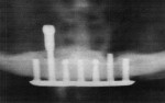 Fig 1. Radiograph from 2009 showing the first fractured left transosseous pin of the transosteal implant, which was salvaged for further use
until the right transosseous pin finally fractured at bone level in 2016.