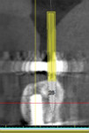 Fig 2. CBCT 3D imaging was used to show the planned placement of the LODI implants lingual to the existing transosteal implant. Pictured is one of the three planned implant
sites.