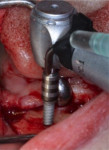 Fig 5. Placement of one of the narrow-diameter implants.
