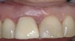Fig 1. Clinical photographs from baseline to post-stabilization. Fig 1 was taken at initial phase of orthodontic extrusion; Fig 2 shows activation; Fig 3 at 1 week; Fig 4 at 2 months; Fig 5 shows stabilization.