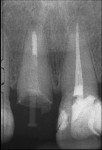 Fig 9. Clinical radiographs comparing pre- (Fig 9) and post- (Fig 10) treatment.
