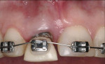 Fig 4. Clinical photographs from baseline to post-stabilization. Fig 1 was taken at initial phase of orthodontic extrusion; Fig 2 shows activation; Fig 3 at 1 week; Fig 4 at 2 months; Fig 5 shows stabilization.