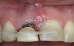 Fig 5. Clinical photographs from baseline to post-stabilization. Fig 1 was taken at initial phase of orthodontic extrusion; Fig 2 shows activation; Fig 3 at 1 week; Fig 4 at 2 months; Fig 5 shows stabilization.