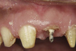 Fig 14. A post was cemented into tooth No. 9 with a hook in the end.