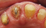 Fig 15. A post was cemented into tooth No. 9 with a hook in the end.