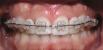 Figure 16c  Comparison of frontal intraoral views at pretreatment, end of treatment,initiation of fixed treatment to parallel roots, and posttreatment. Clear alignertreatment was repeated for 6 months to finish treatment because patient wantedfixed a