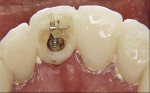 Fig 16. An elastic was connected between the post and a metal bar on the temporary crown at the coronal position. Tooth No. 9 was extruded using an elastic along the long axis of the tooth.