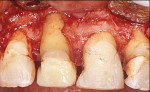 Fig 11. Loss of facial plate around tooth No. 8
was evident upon surgical entry.