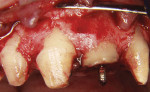 Fig 17. Upon surgical exposure, a coronal deposition of alveolar bone was evident along the extruded root.