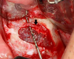 Fig 3. Intraosseous artery in the buccal plate, opposite the left maxillary sinus, has been exposed using piezosurgery.