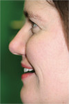 Figure 10  Patient at try-in showing good lip support.