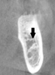 Fig 10. Bone marrow space at site No. 30 that is greater that 2 mm tall and wide.